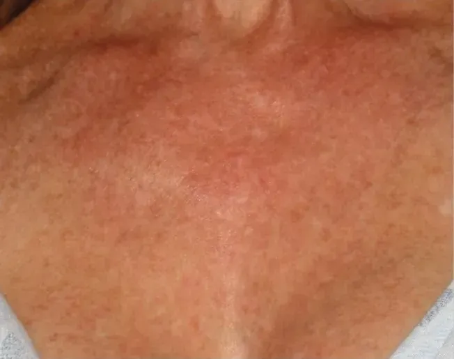 фото до процедуры BBL Vascular