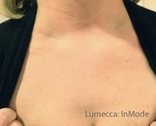 фото после процедуры фотоомоложения на аппарате Lumecca