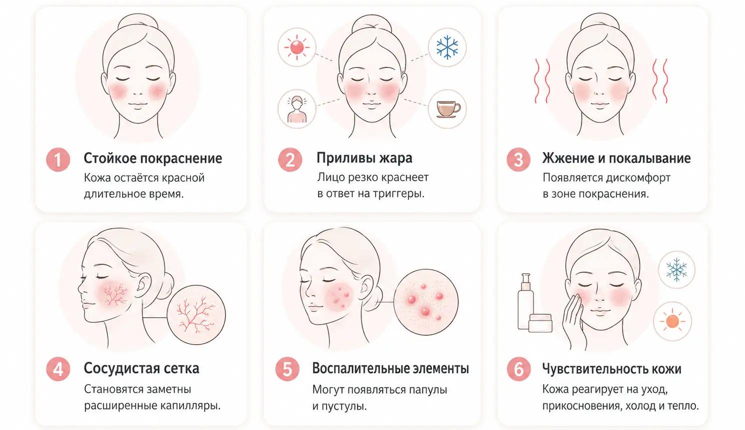 Зоны проявления купероза на лице