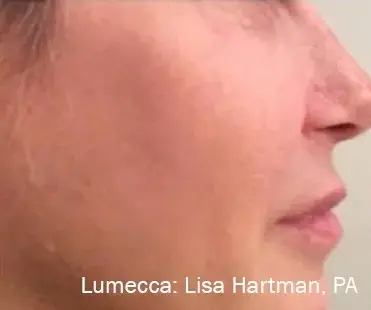 фото после процедуры фотоомоложения на аппарате Lumecca