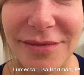 фото после процедуры фотоомоложения на аппарате Lumecca