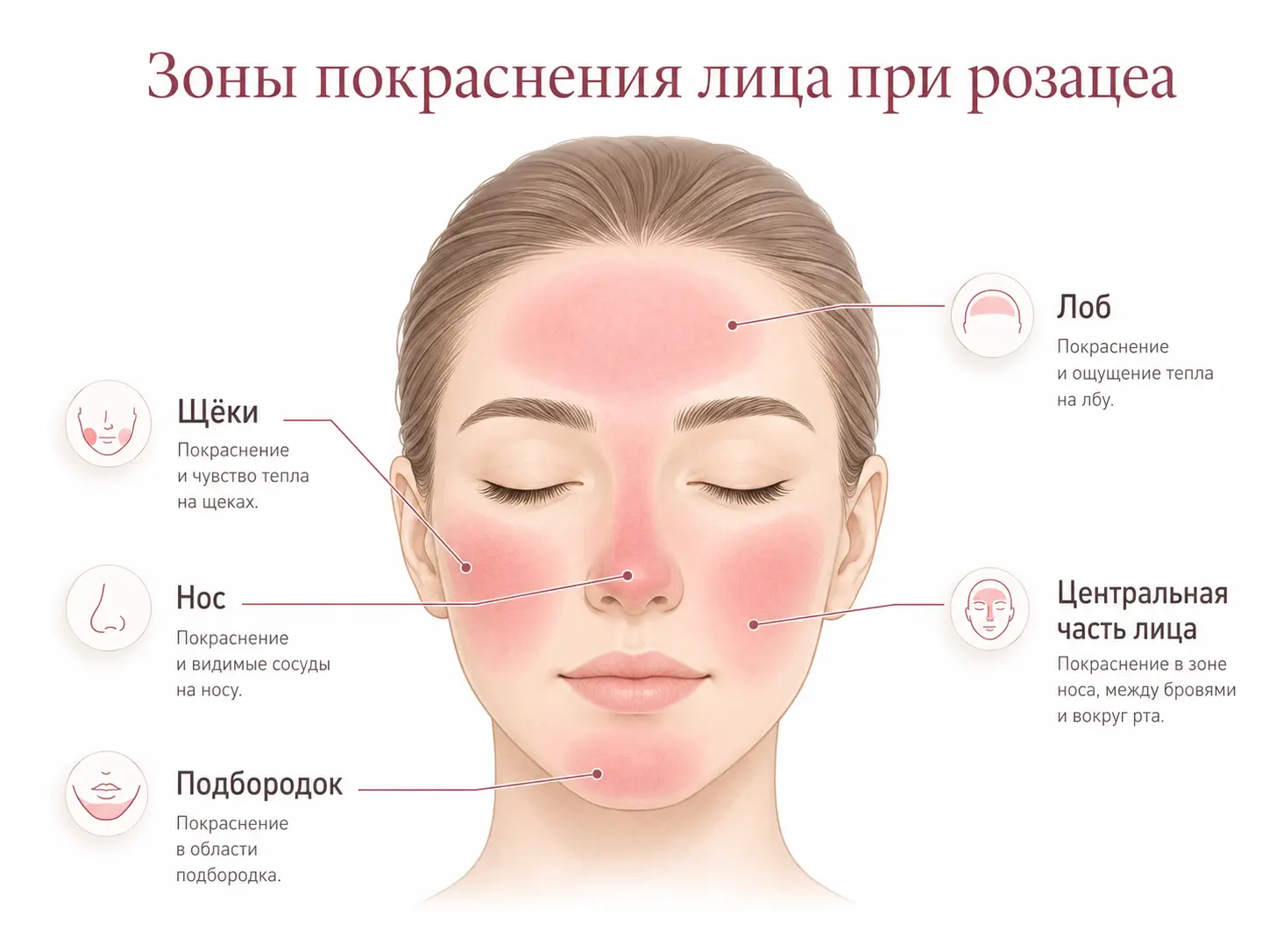 Зоны проявления купероза на лице