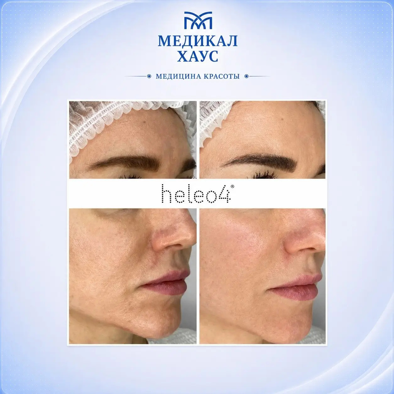 Heleo4