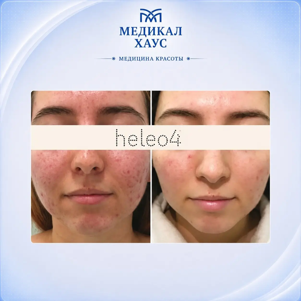 Heleo4